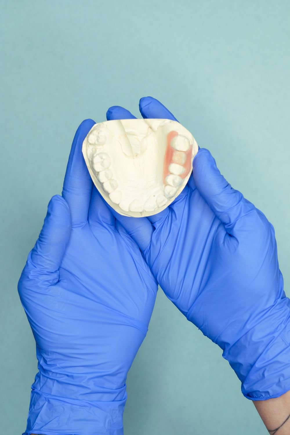 Modelo dental sostenido con guantes para planificar una restauración; fotografía ilustrativa